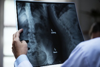 Röntgenaufnahme einer Wirbelsäule - Stehpaddeln stärkt den Rücken